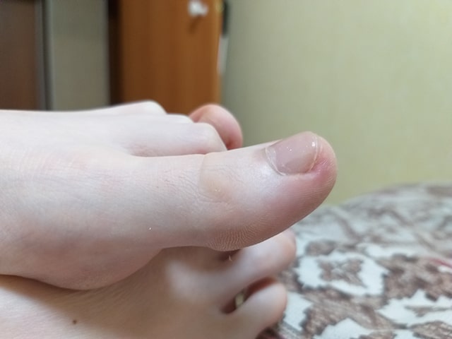 большой палец на ноге